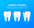 Stage of development of caries. Dental care concept. Healthy Teeth. Vector illustration.